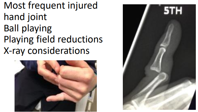 <p>PIP dislocation - dorsal</p>