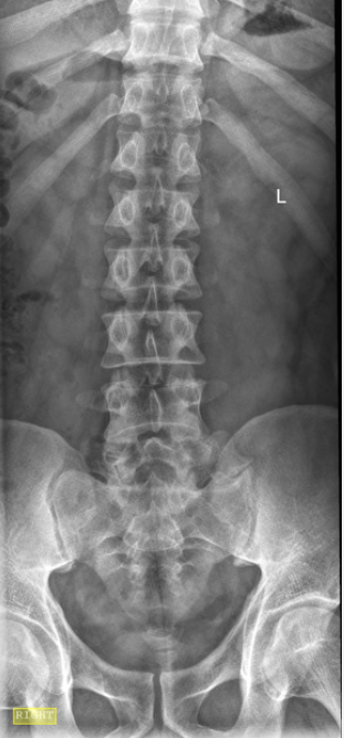 <p>6 lumbars (1st sacral segment appears like a lumbar segment)</p>