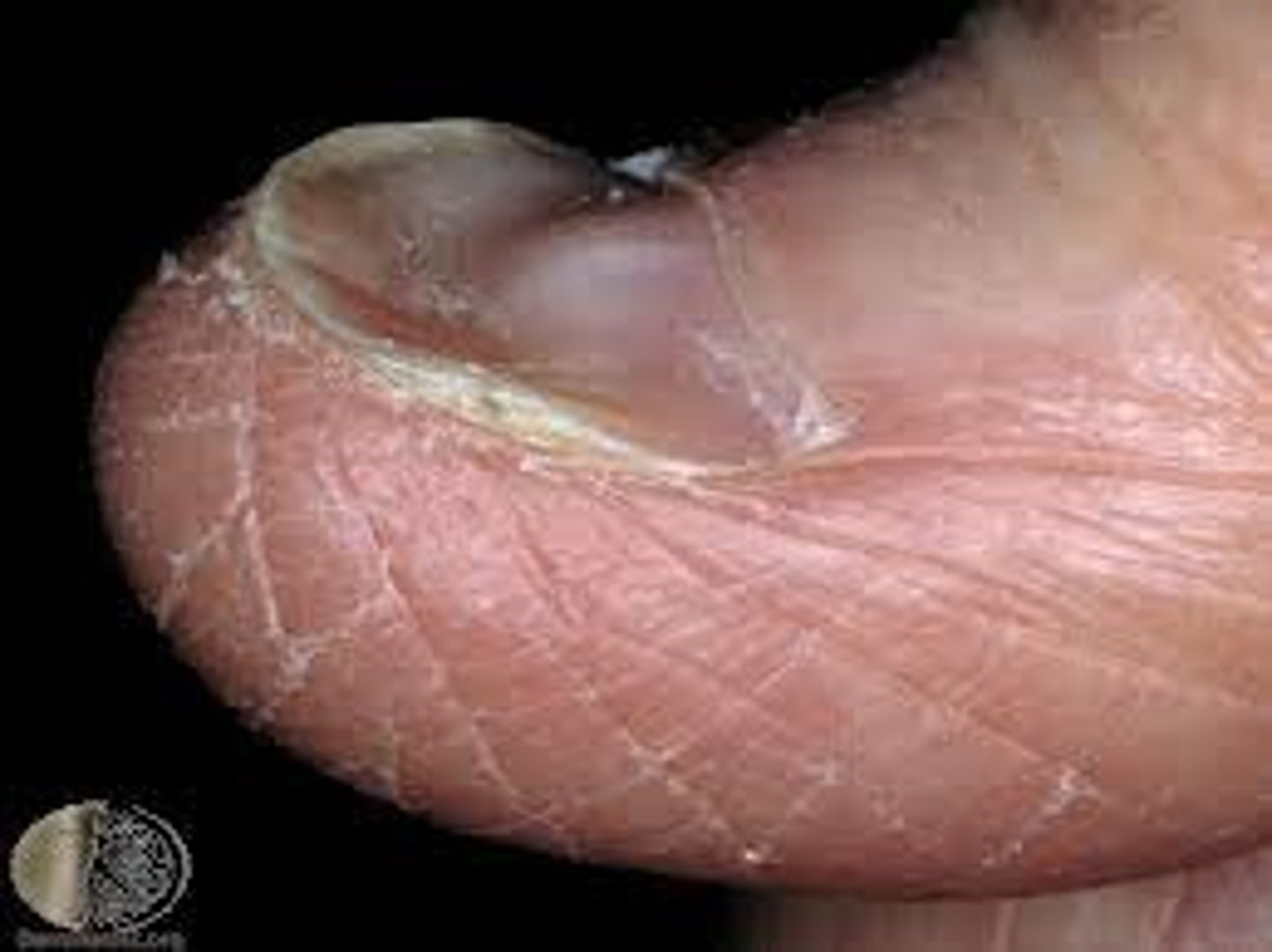 <p>a malformation of the nails in which the outer surface is concave or scooped out like the bowl of a spoon</p>