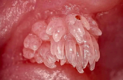 <p>benign growth caused by the <span style="color: red;">human papillomavirus (HPV)</span></p><p>refers to a<span style="color: red;"> small nipple shaped epithelial tumor</span> which cells are covered with <span style="color: red;">finger like process of stroma </span>neoplastic lesion</p>