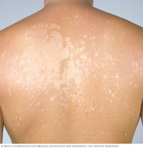 <p>Tinea Versicolor</p>