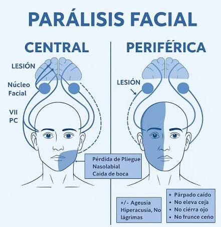 <ul><li><p>Alteració del <strong>VII parell cranial (Nervi facial)</strong>. </p></li><li><p>El pacient presenta paràlisi de tota la meitat de la cara afectada (no pot arrugar el front, ni somriure, ni tancar l'ull).</p></li><li><p><strong>Prioritat d'infermeria:</strong> Protecció ocular (llàgrimes artificials de dia, oclusió amb gasa i esparadrap de nit per evitar úlceres cornials). </p></li></ul><p></p>