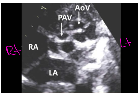 <p><strong>Aorta </strong>is positioned <strong>leftward </strong>and <strong>anterior </strong>to the <strong>pulmonary artery</strong></p><p>(The normal is aorta is rightward and posterior to the pulmonic valve)</p>