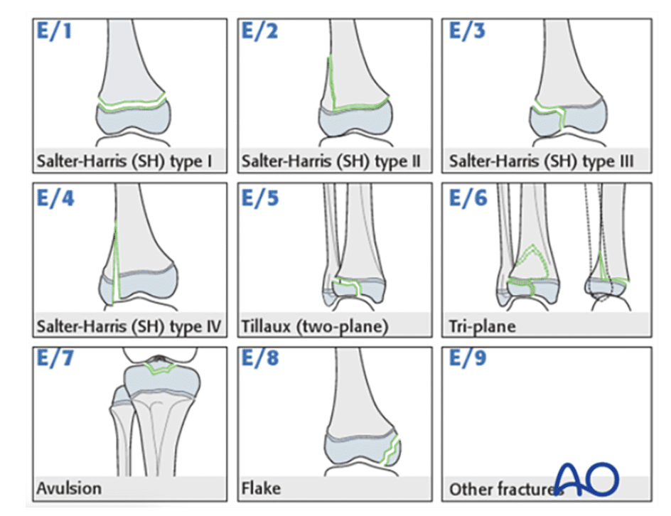 <p><strong>Salter-Harris/AO Fracture Classification System</strong></p>