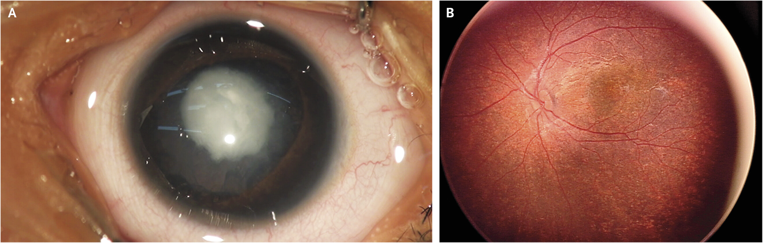 <p>Congenital rubella syndrome eye</p>