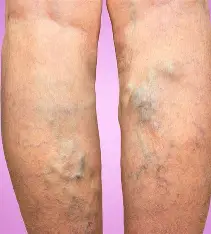 <p>dilated, tortuous veins, caused by incompetent valves, risk factors include obesity, pregnancy, standing for long periods</p>