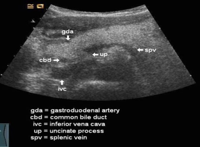 <p>Can be seen at the anterior lateral margin</p>