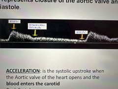 <p>represents the closure of the aortic valve and the onset of diastole</p>