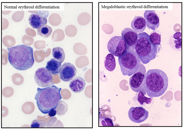 <p>Bone Marrow: Megaloblastic Anaemia</p>