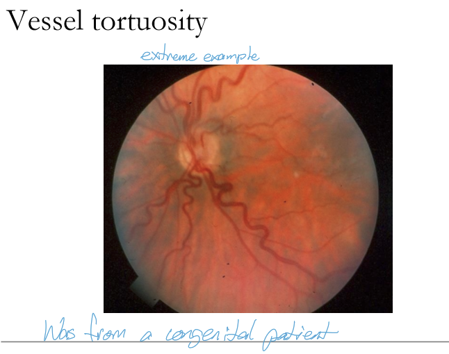 <p>Retinal vessel tortuosity occurs <strong>most commonly in the retinal veins</strong> because venous walls are thinner and more susceptible to dilation and distortion under increased venous pressure or hypoxic stress.</p>