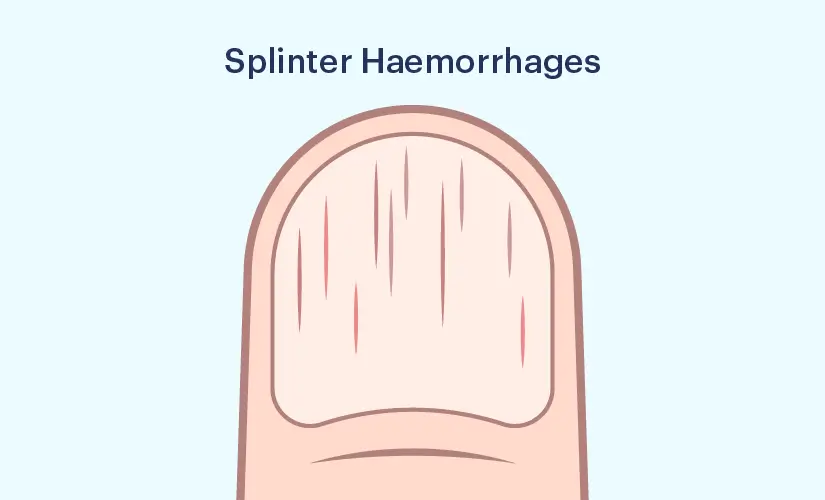 <ul><li><p>Small, linear hemorrhages under the nails that are usually asymptomatic</p></li></ul><p></p>