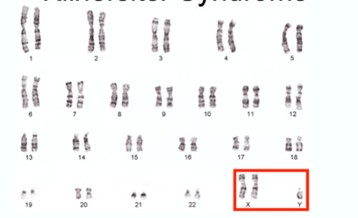 <p>Klinefelter Syndrome, XXY</p>