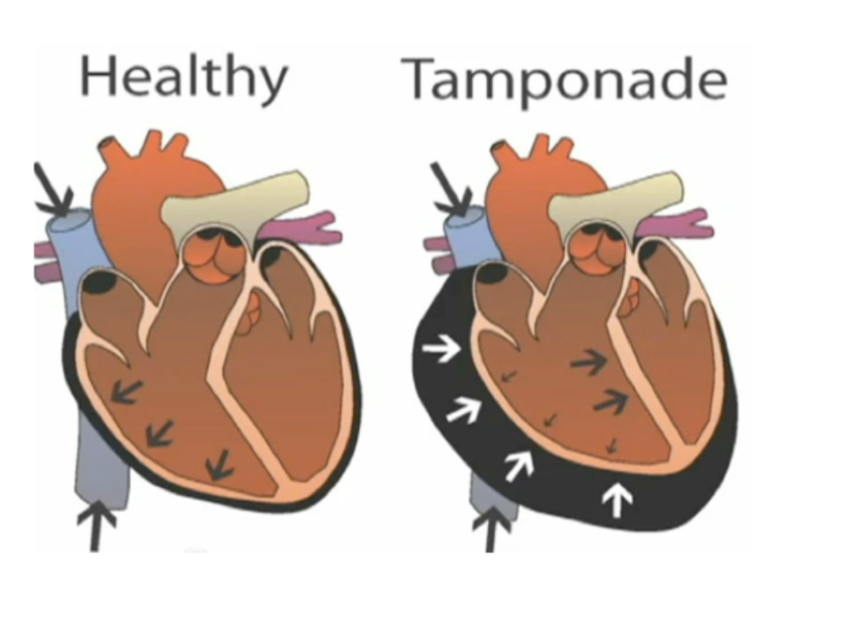 <p>After there is trauma to the heart, the pericardial sac fills up leading to the narrowing of the ventricles (and heart chambers) </p><ul><li><p>This means that the heart cannot fill up properly in diastole leading to the blood being backed up into the veins (shown as bulging neck veins) (↓ Filling → ↓ stroke volume → ↓ cardiac output)</p></li></ul><ul><li><p>Since there is less blood pumped it leads to hypotension </p></li></ul><p></p>