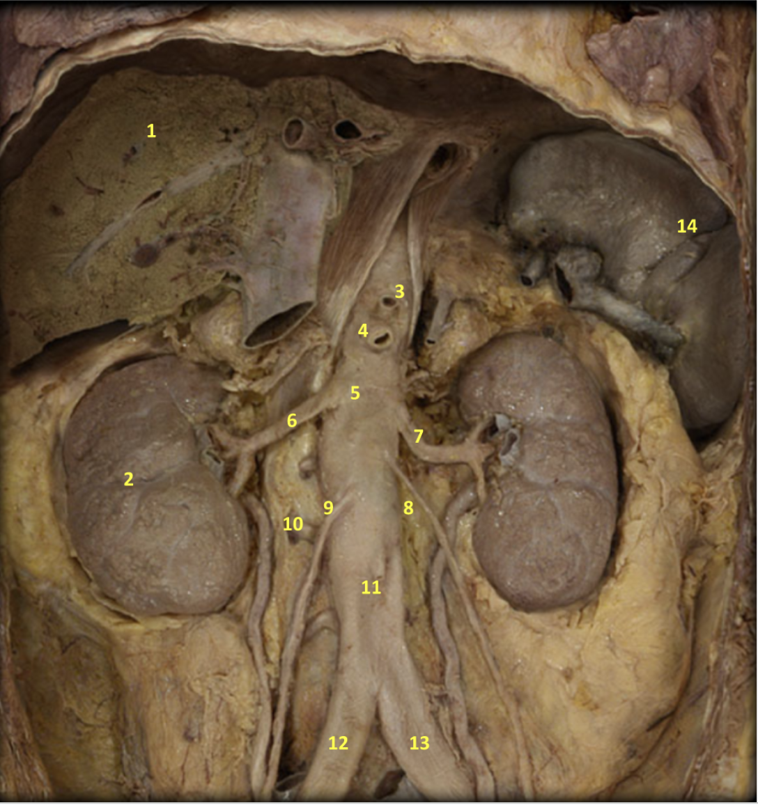 <p>Abdomen - Even Even Even Deeper Dissection</p><p>1. Liver</p><p>2. Kidney</p><p>3. Celiac artery</p><p>4. Superior mesenteric artery</p><p>5. Abdominal aorta</p><p>6. Right renal artery</p><p>7. Left renal artery</p><p>8. Left gonadal artery</p><p>9. Right gonadal artery</p><p>10. Left lumbar artery</p><p>11. Inferior mesenteric artery</p><p>12. Right common iliac artery</p><p>13. Left common iliac artery</p><p>14. spleen</p>