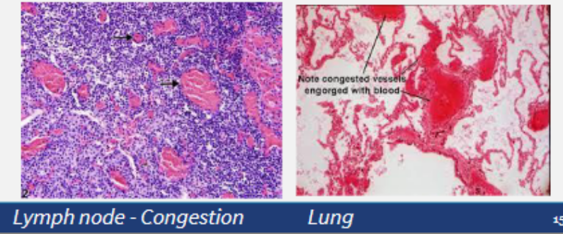 <p>Fluid loss + increased vessel diameter —> slower blood flow</p><p>Increased concentration of red cells —> increased viscosity of blood</p><p></p><p>Slower blood flow + increased viscosity stasis —> stasis </p><p></p><p>Stasis is observed as vascular <em>congestion</em></p><p>• Allows leukocytes to accumulate on the vascular endothelium</p><p>• Endothelial cells are activated by mediators of inflammation, so express increased levels of adhesion molecules</p><p>• Leukocytes can then adhere to the endothelium and then migrate through the vessel wall</p>
