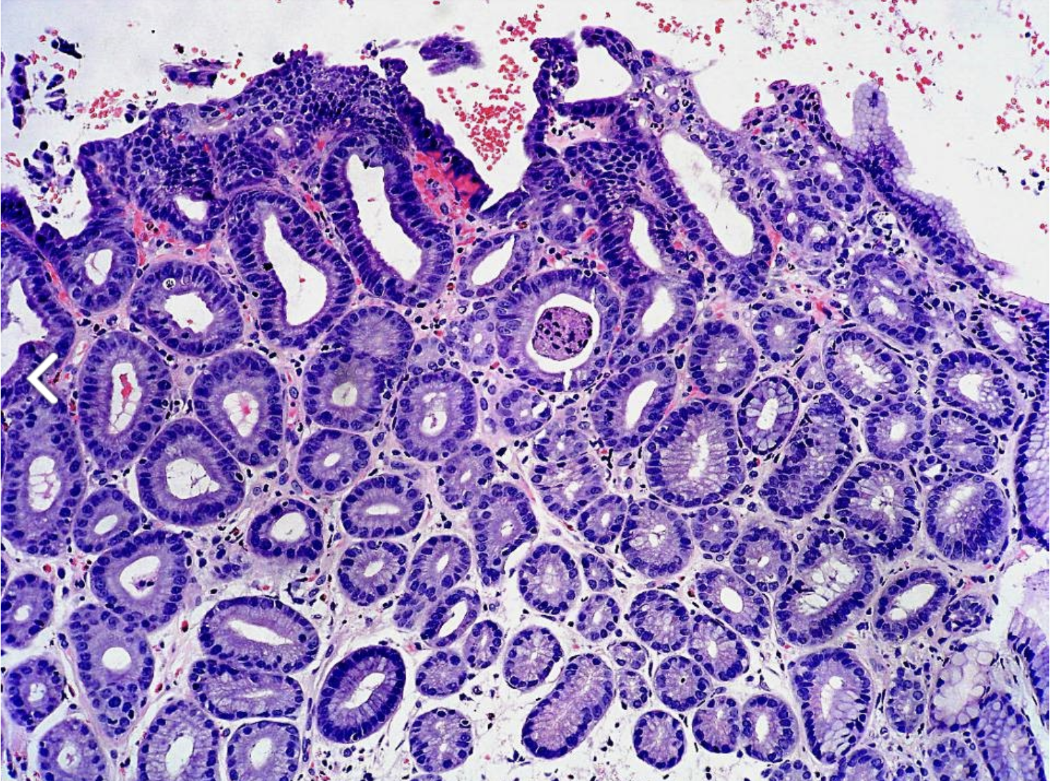 <p>Polype gastrique</p><p>1) diagnostic</p><p>2) contexte</p><p>3) histo</p><p>4) IHC typique</p><p>5) moléculaire </p>