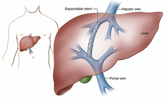 <p>Define Portosystemic Shunting (TIPS)</p>