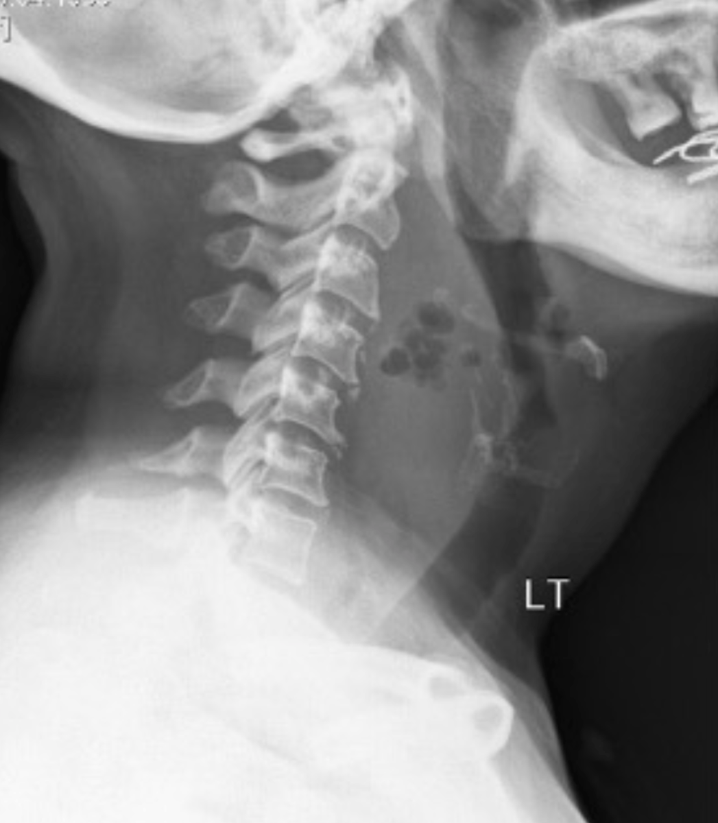 <p>What is your finding or diagnosis? (honestly I'm not sure which this is classified as)</p>