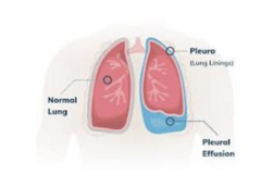 <p>fluid collection in pleural space (an underlying cause could be cancer), you will hear diminished lung sounds</p>