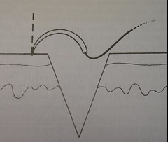 <p>B. The needle entry angle that optimizes eversion of sutured skin edges.</p><p>The answer is B. Eversion of the skin edges is maximized by directing the needle entry as shown in the figure. Injection for local anesthesia should usually be performed through the wound, rather than through intact skin. Use of skin clamps can damage tissue; in cases where skin stabilization is needed gentle forceps application is preferred. Subcuticular sutures are placed deep to the skin.</p>