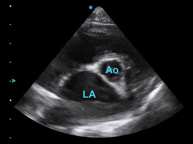 <p>LA:Ao ratio</p>
