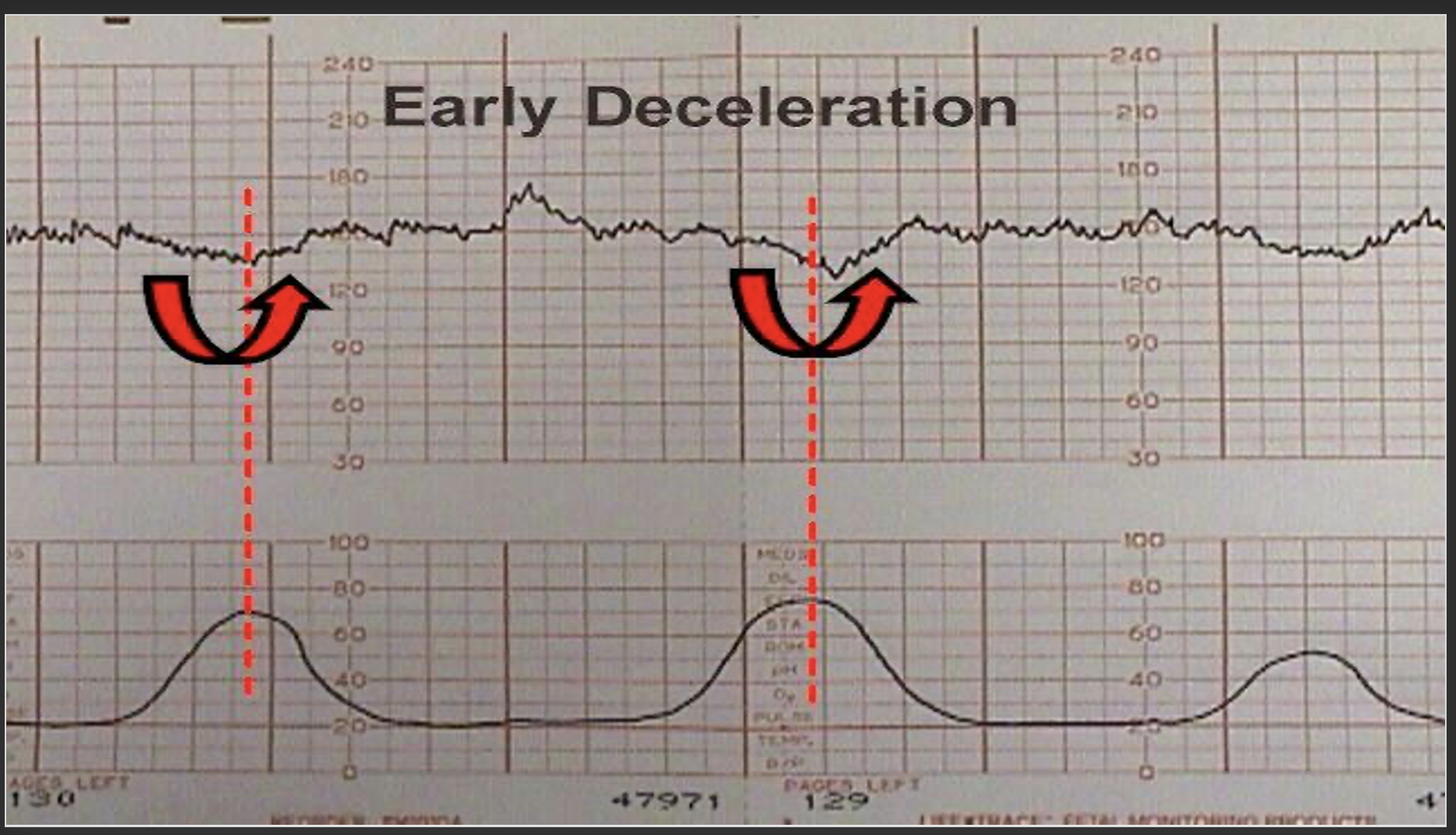 <p>Early Deceleration</p>