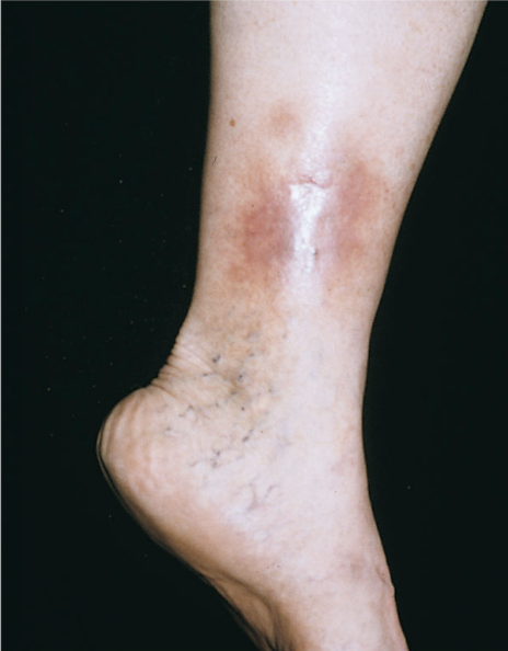 <ul><li><p>Erythema</p></li><li><p>progressing</p><ul><li><p>pruritus</p></li><li><p>scaling</p></li><li><p>petechiae</p></li><li><p>ulcerations. + changes in shape of leg</p></li></ul></li></ul><p></p>