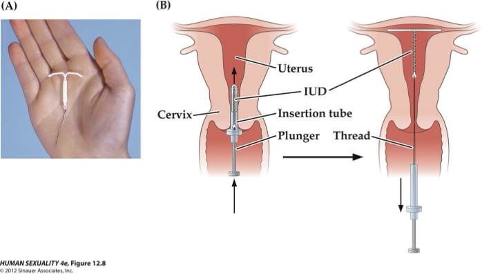 <ul><li><p><strong>IUD:</strong> Device inserted <em>inside the uterus</em>; T-shaped, fans out in uterus.</p></li></ul><ul><li><p><strong>Types:</strong> Progestogen (hormonal) IUD.</p></li><li><p><strong>Mechanism:</strong></p><ul><li><p>Delivers <strong>steady daily hormone</strong>.</p></li><li><p><strong>HPG axis adjusts</strong> → silences natural hormonal fluctuations.</p></li><li><p>Eliminates natural cycle peaks and dips; body senses <strong>constant hormone levels</strong>.</p></li></ul></li></ul><p></p>