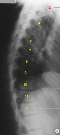 <p>Lateral T-Spine: Is this Image Good?</p>