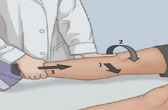 <p>Medial tibial rotation and valgus stress during flexion/extension; indicates ACL rotary instability.</p>
