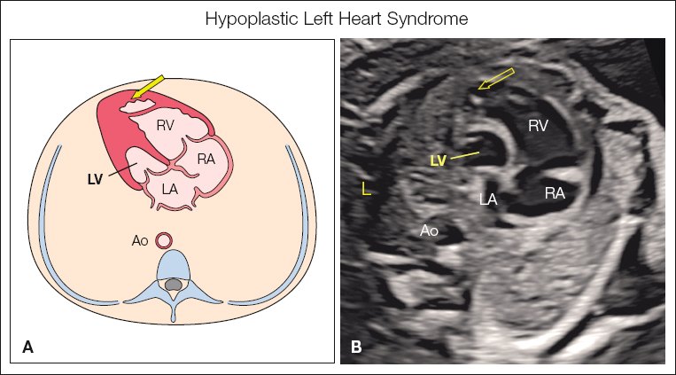<p>Absent or small left ventricle</p><p>No communication between the left atrium and the left ventricle</p><p>Aortic atresia (possibly)</p><p>Aortic stenosis (possibly)</p><p>Coarctation of the aorta (possibly)</p>