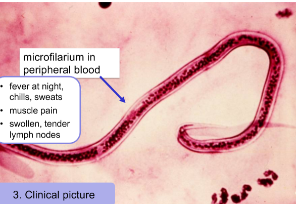 <p>Diagnosis is looking at microfilarium in blood smear (must do at night, as thats when are found in blood)</p><p>distinct sheathed microfilarium in peripheral blood</p><ul><li><p>looks like a worm</p></li></ul><p>Cause adutls in lymphatics, very hard to get </p><ul><li><p>but Can also use serology</p></li></ul><p></p>