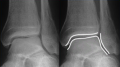 <p>"socket" or three-sided opening The superior Talus fits in here • Not seen on a true AP in full</p>