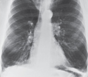 <p>Distension of the distal air spaces as a result of the destruction of alveolar walls and obstruction of small airways.</p>