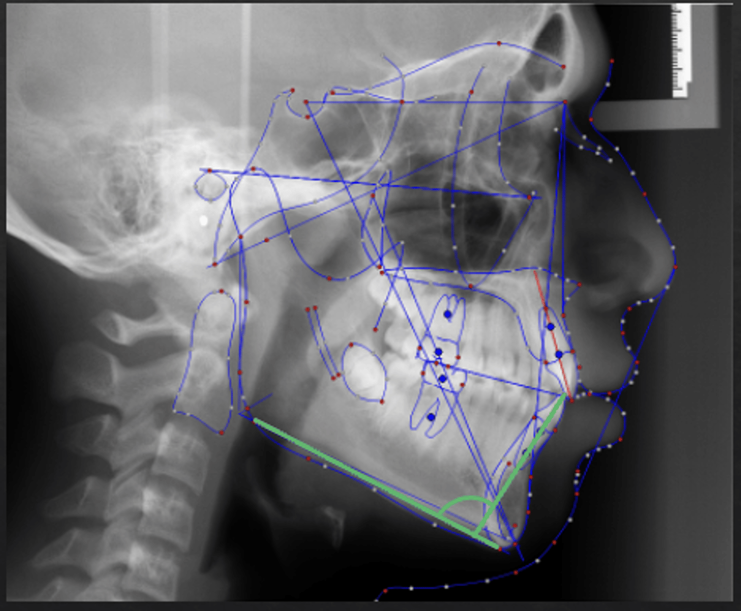 <p>What dental measurement:</p><p>- Mandibular Plane vs Long Axis of L1</p><p>- AP relationship between the body of the mandible and the lower incisors</p><p>- Tells you about the angulation of the lower incisors</p>