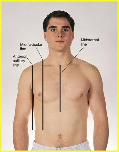 <p><span>A </span><strong>clavicle</strong> is your collarbone—the small, curved bone running horizontally across the top of your chest, connecting your shoulder to your breastbone. <mark>A </mark><strong><mark>midclavicular line</mark></strong><mark> is an imaginary vertical line running straight down your body starting exactly from the midpoint of that collarbone</mark>. [1, 2, 3]</p><p>The Clavicle (Collarbone)</p><ul><li><p><span><strong>What it is:</strong> A palpable, long, slightly S-shaped bone located at the base of the neck.</span></p></li><li><p><span><strong>Function:</strong> It acts as a strut to keep your shoulder blades in place, allowing your arms a wide range of motion. It also protects important nerves and blood vessels traveling from your neck to your arm.</span></p></li><li><p><span><strong>Feel it:</strong> You can easily feel the clavicle just under the skin on the upper chest.</span> [1, 2, 3, 4, 5]</p></li></ul><p>The Midclavicular Line (MCL)</p><ul><li><p><span><strong>What it is:</strong> An imaginary reference line that starts at the exact middle of the clavicle and runs vertically down the front of your torso.</span> [1]</p></li><li><p><span><strong>Function in Medicine:</strong> Doctors and healthcare professionals use the MCL as a standard landmark to accurately map out and describe the positions of internal organs.</span> [1, 2]</p></li><li><p><span><strong>Common Uses:</strong></span></p><ul><li><p><span><strong>Listening to the Heart:</strong> It helps locate the "apex beat" (the point of maximum impact for the heart) so a doctor knows exactly where to place a stethoscope.</span></p></li><li><p><span><strong>Assessing the Liver:</strong> It is used to measure liver size and detect if the liver is enlarged.</span></p></li><li><p><span><strong>Abdominal mapping:</strong> It divides the abdomen into nine distinct regions.</span></p></li><li><p><span><strong>Emergency procedures:</strong> It is a key reference point for performing safe needle decompression of a collapsed lung (pneumothorax)</span><br><br></p></li></ul></li></ul><p></p>