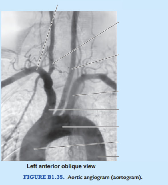 <p>Label the coronary angiogram </p>