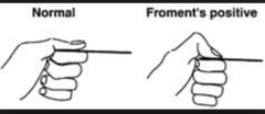 <p>thumb IP flexion during lateral pinch attempt.</p>