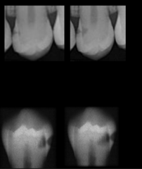 <p>triangular radiolucency with base at CEJ</p>