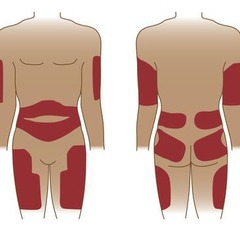 <p>Back of the arm (fatty tissue)</p>