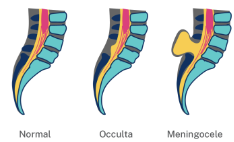 <p>Protrusion of meninges (connective tissue surrounding the spinal cord) and CSF but not the spinal cord</p>