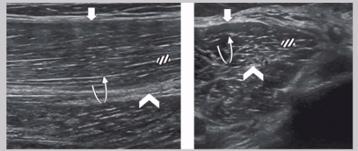 <ul><li><p><span style="background-color: transparent;">LAX </span></p><ul><li><p><span style="background-color: transparent;">Homogeneous with multiple parallel echoes</span></p></li><li><p><span style="background-color: transparent;">“Feather” appearance - striated pennate appearance</span></p></li><li><p><span style="background-color: transparent;">Hypoechoic muscle fibers arranged in columns interspersed by hyperechoic fibroadipose tissue</span></p></li></ul></li><li><p><span style="background-color: transparent;">SAX </span></p><ul><li><p><span style="background-color: transparent;">Homogeneous with punctuate echoes</span></p></li></ul></li></ul><p></p>