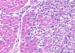 <p>Is this lesion?</p><p>A. Inflammatory</p><p>B. Degenerative</p>