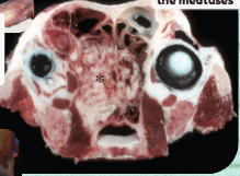 <p>What broad <strong>neoplasia</strong> category of the upper respiratory tract is primarily malignant, observed mostly in medium-to-large breed dogs, and frequently masquerades as infectious rhinitis?</p>