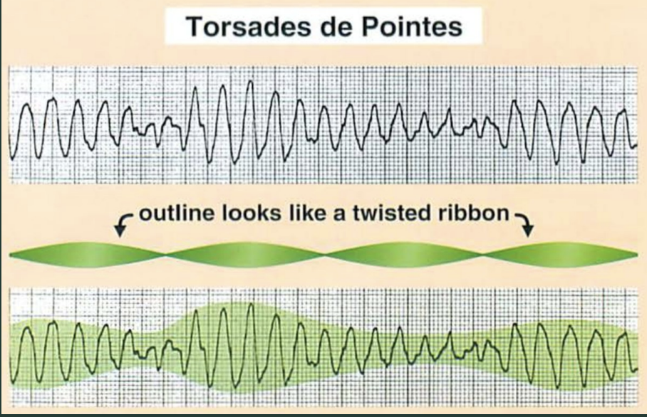 <p>What defines torsades de pointes?</p>