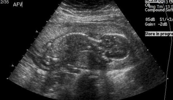 <ul><li><p>oligohydramnios</p></li><li><p>anhydramnios</p></li></ul><p></p>