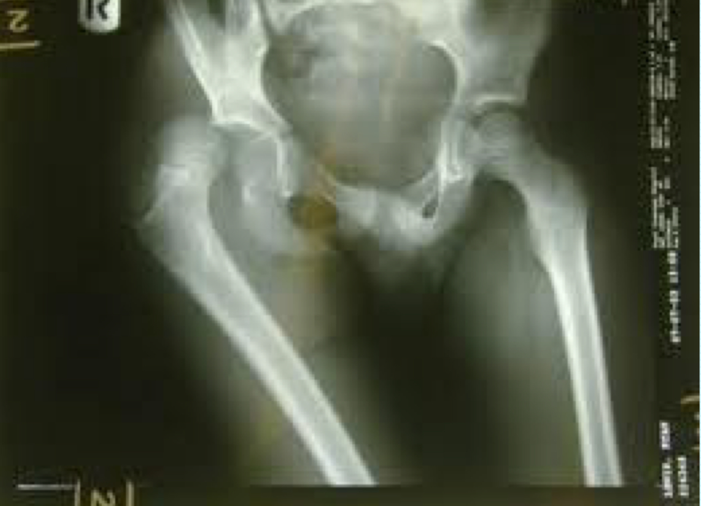 <ul><li><p>occurs when the neck of the femur is almost straight with no angle due to non-weightbearing</p></li><li><p>this can cause the femoral head to slide above the acetabulum </p></li><li><p>the straight bone will also affect ROM so you cannot achieve the pelvis to get much hip flexion</p></li></ul><p></p>