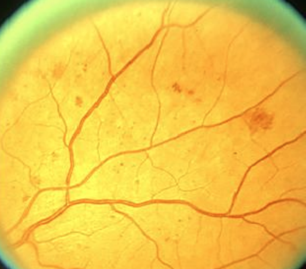 <p>DR classification: </p><p>** assume this is what all 4 quadrants look like</p>