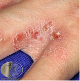 <p>Presentation: intense pruritus (worse at night), burrows in interdigital webs, wrists, axillae.</p>