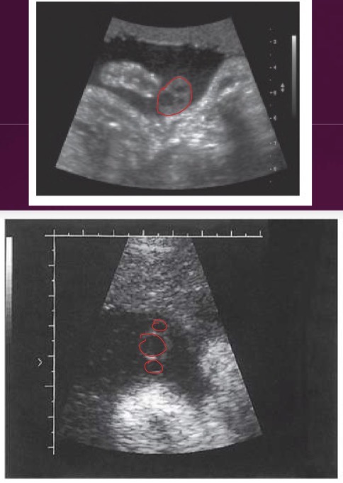 <p>Well visualized at 8 weeks; grows at rate similar to embryo; composed of 2 umbilical arteries and 1 umbilical vein; develops multiple spiral turns </p>